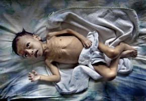 A Guatemalan child being treated at a health center for malnourished children